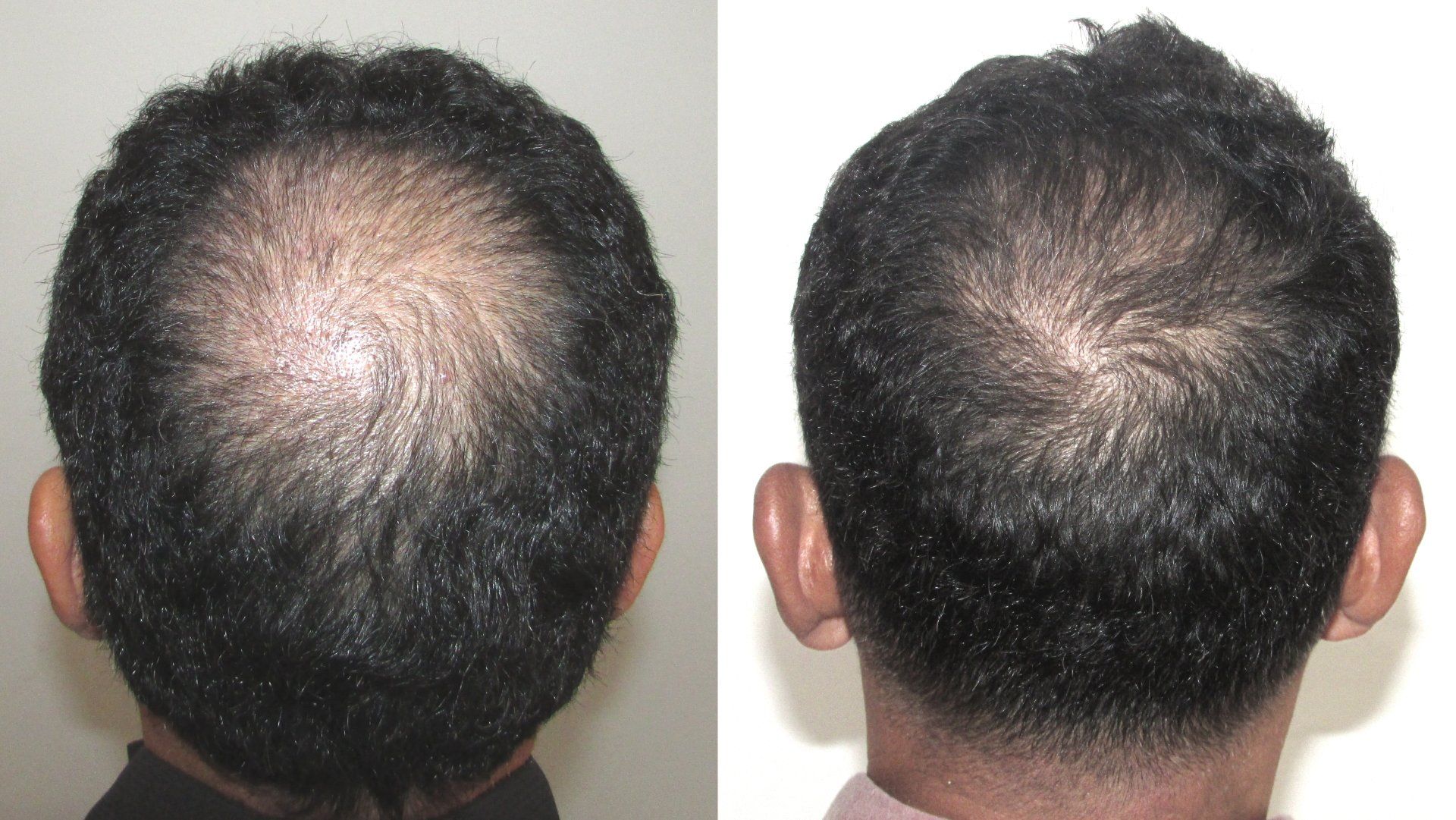 before and after hair regrowth pictures