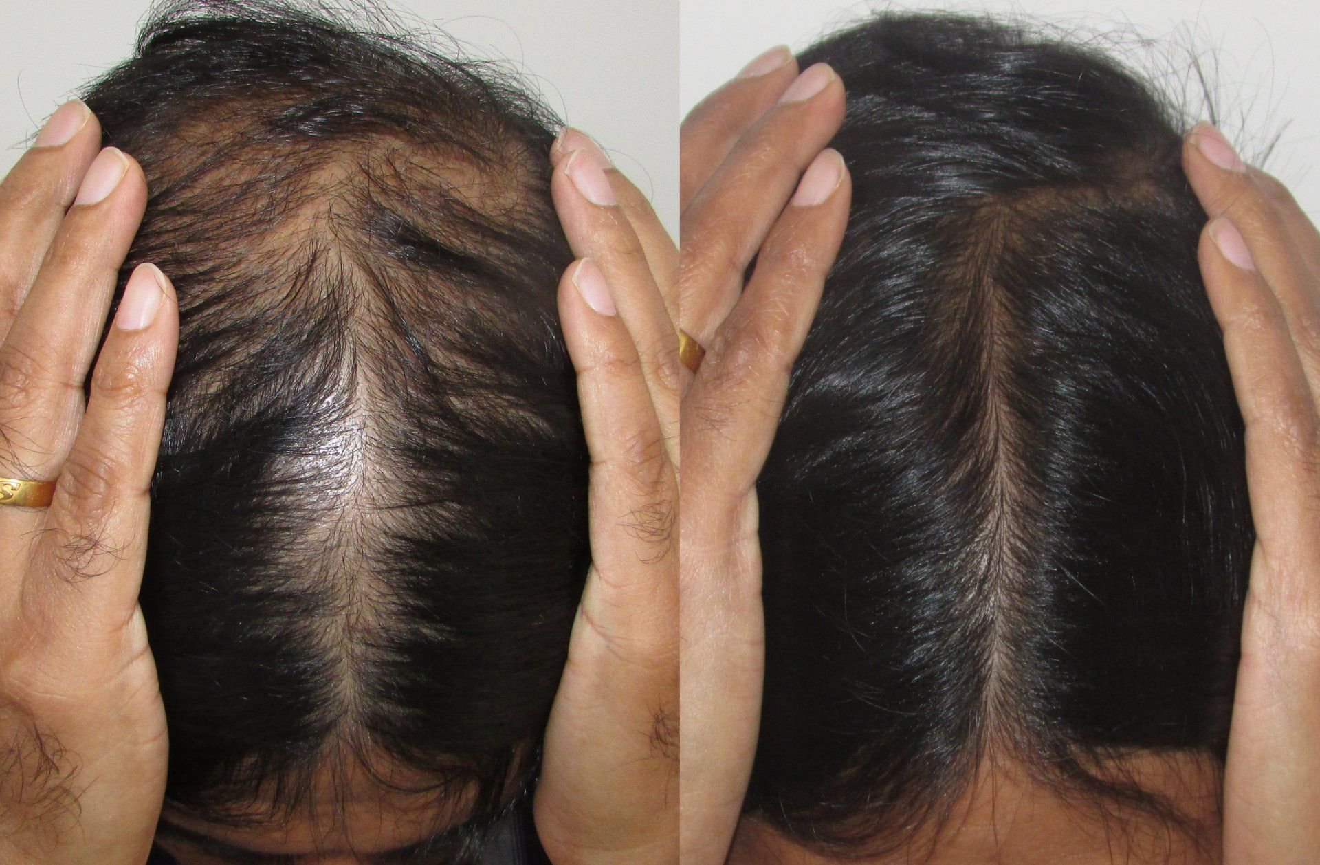 Hair Loss Treatment