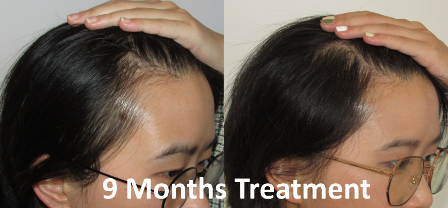 female pattern baldness with receding temples before and after pictures