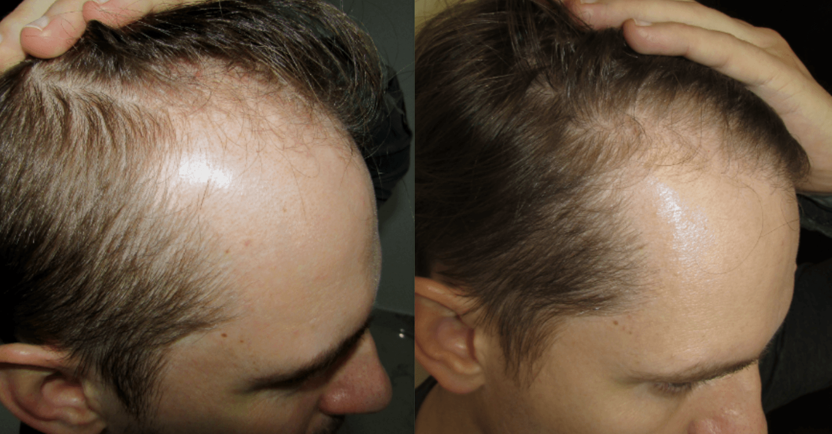 Hair Loss Treatment