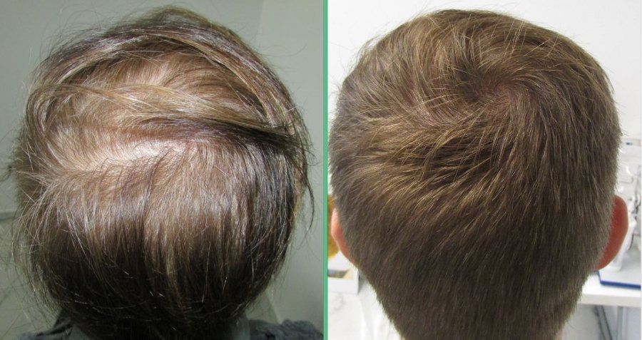 hair regrowth by stop and regrow 12 months