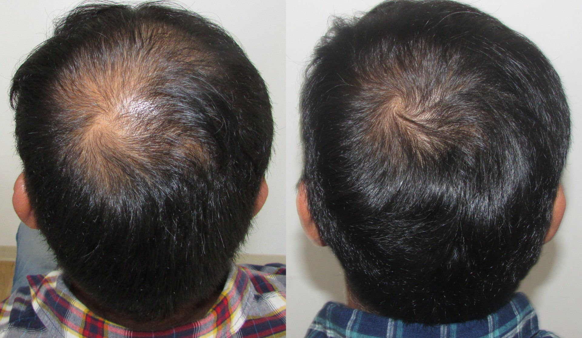 crown hair regrowth