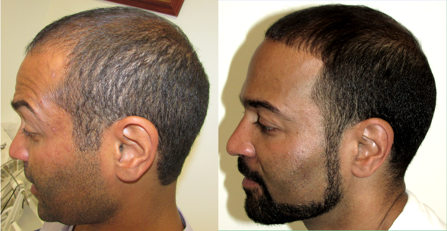 Best hair regrowth product