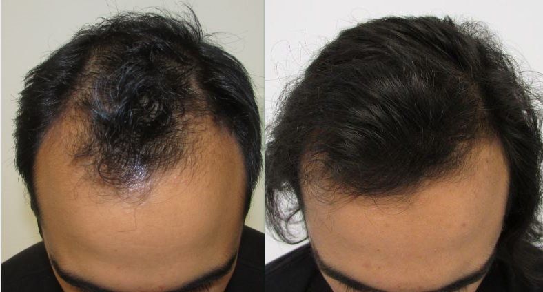 before and after 