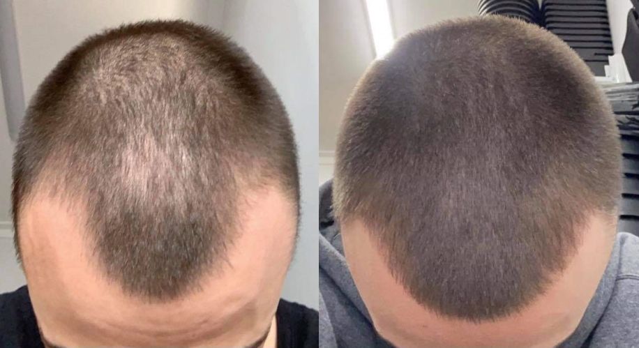 cleve 2 years of stop and regrow hair growth review