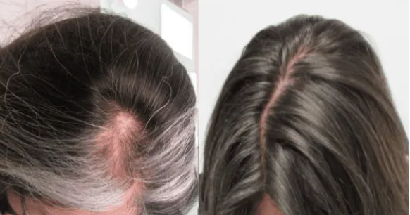 auto immune areata alopecia hair regrowth before and after pics