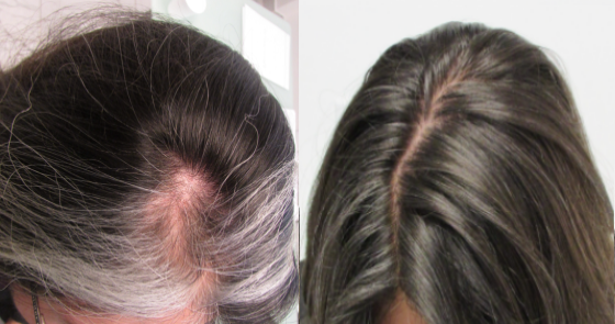 alopecia areata - what is it and what causes it?