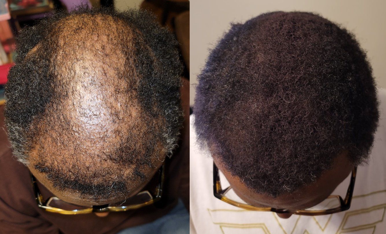 donnell's hair regrowth - only 9 months unbelievable

