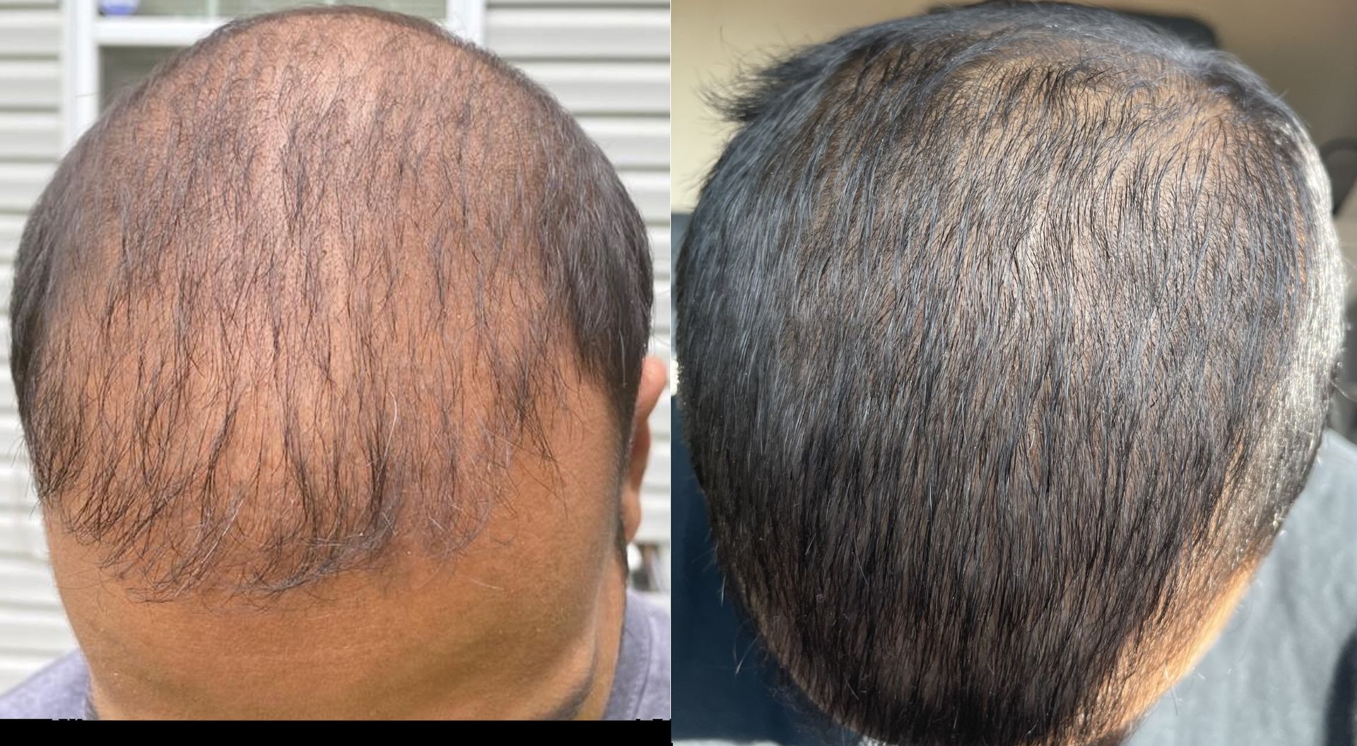 hamer stop and regrow review - before and after