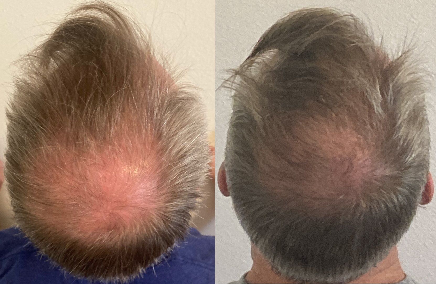 crown hair regrowth