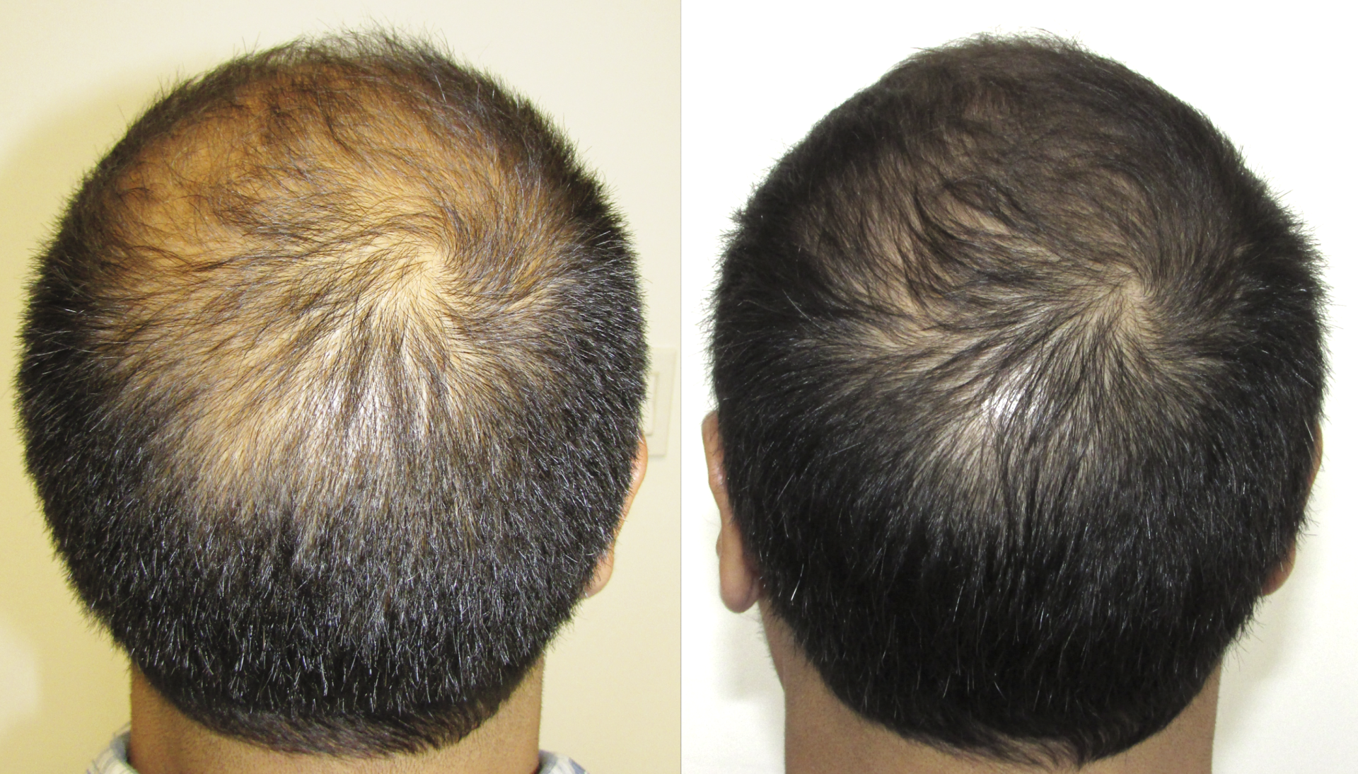 before and after stop and regrow pics