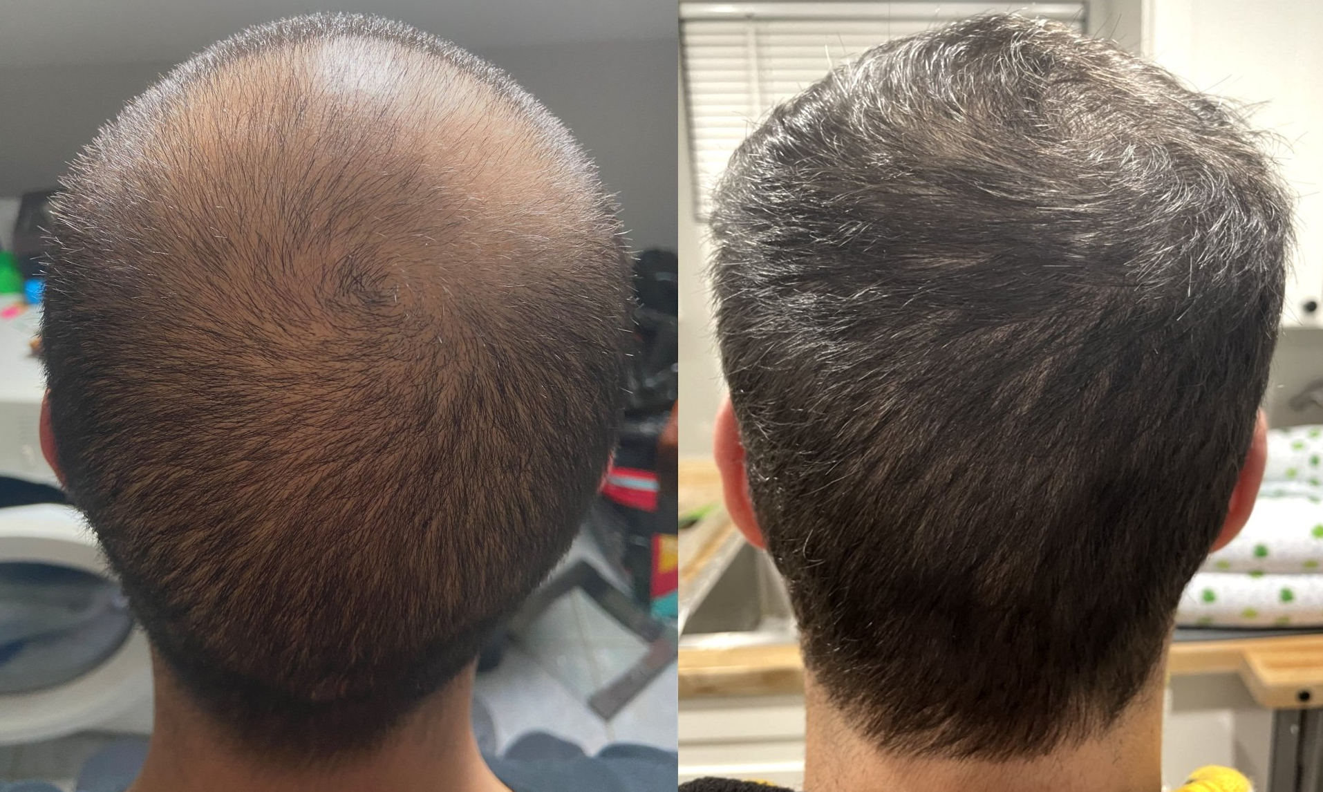 Hair Loss Treatment