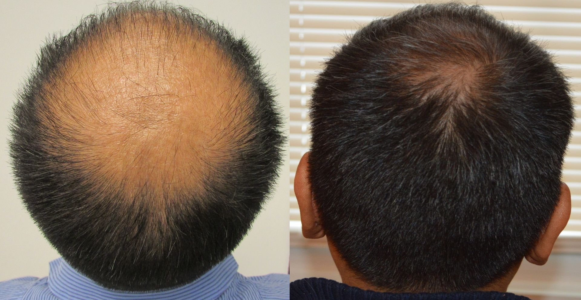 Best hair regrowth product