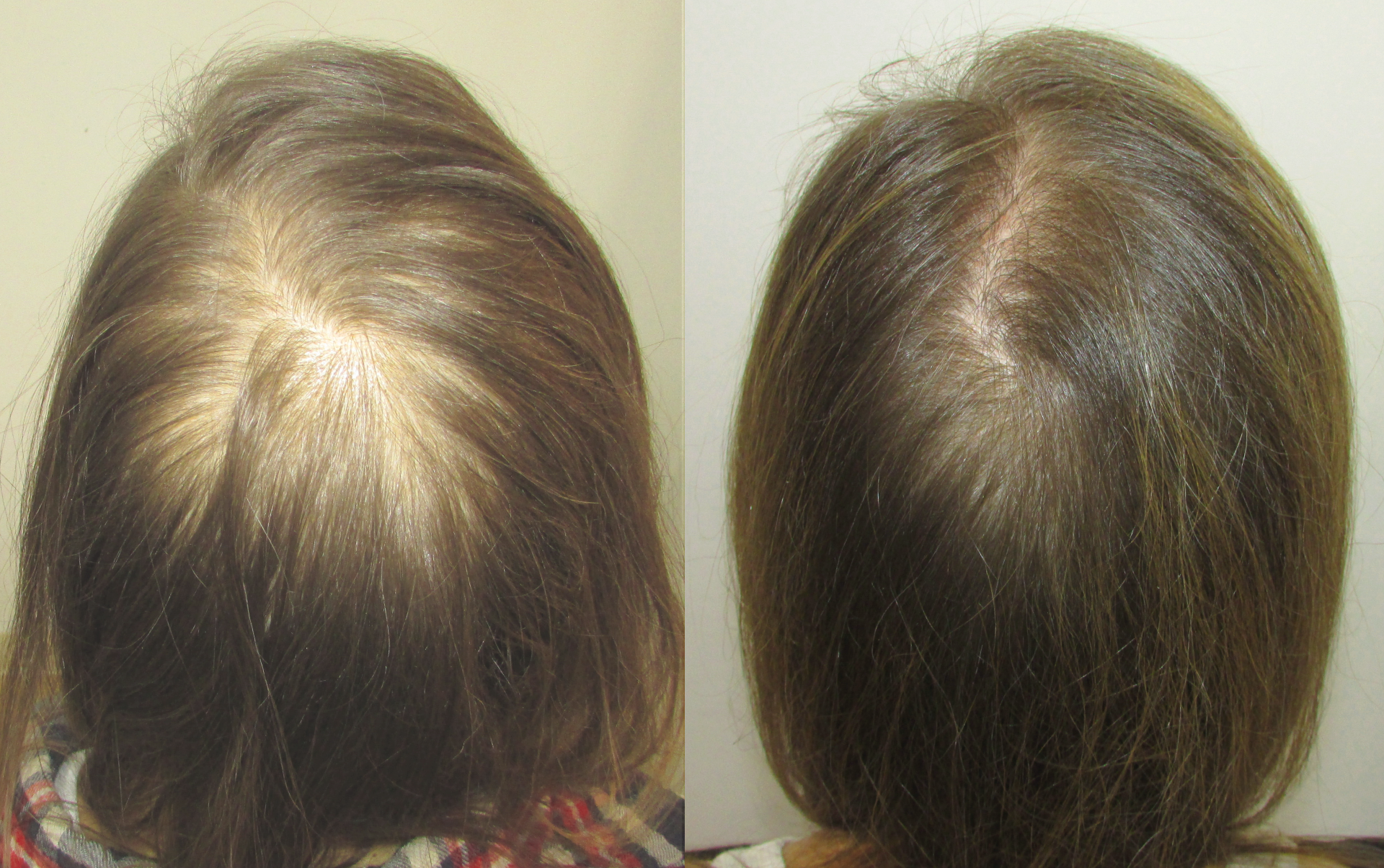 best hair regrowth for women reviews