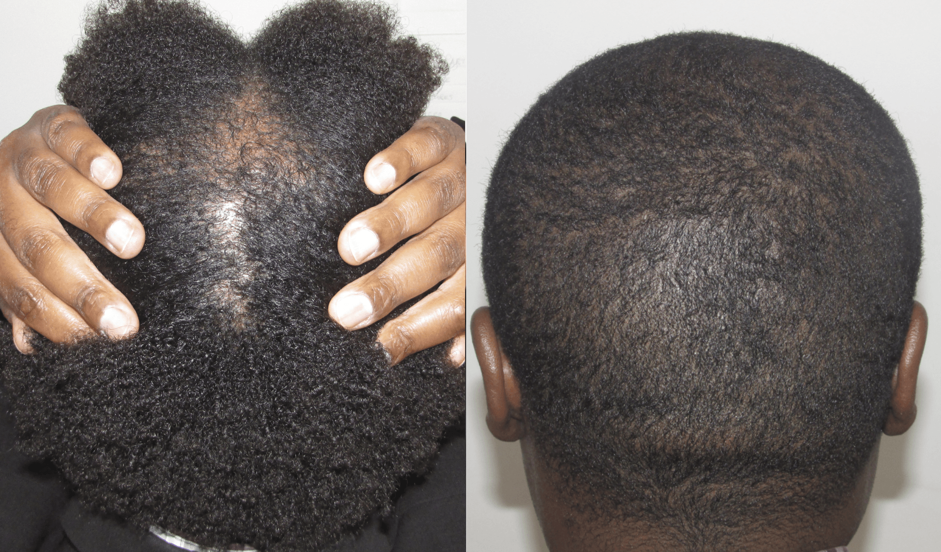 nicholas before and after hair regrowth review