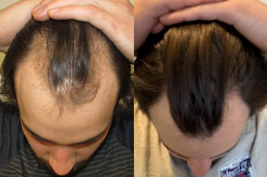 james 7 month hair regrowth before and after images