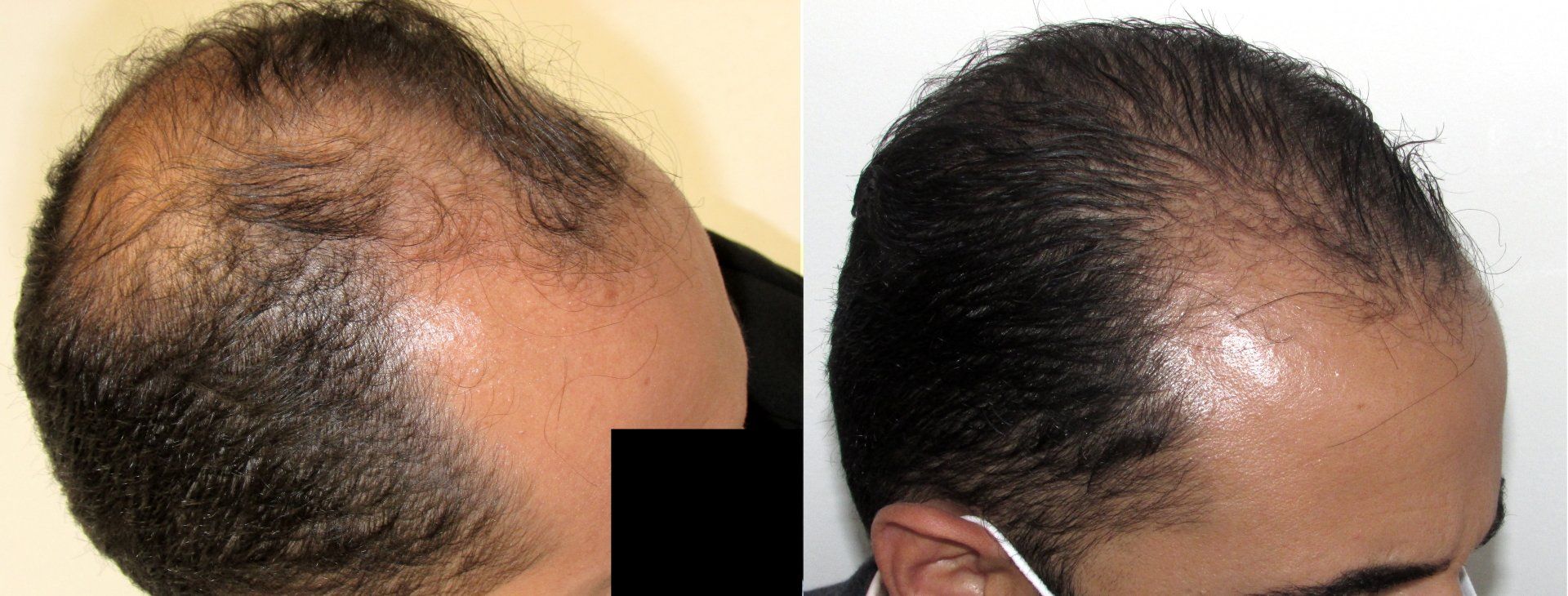 sam 2 years hair regrowth progress