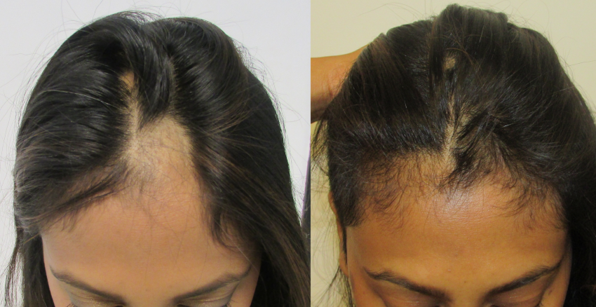 Hair Loss: Understanding Autoimmune Areata Alopecia (AAA)