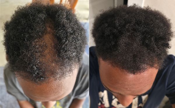 male auto immune areata before and after