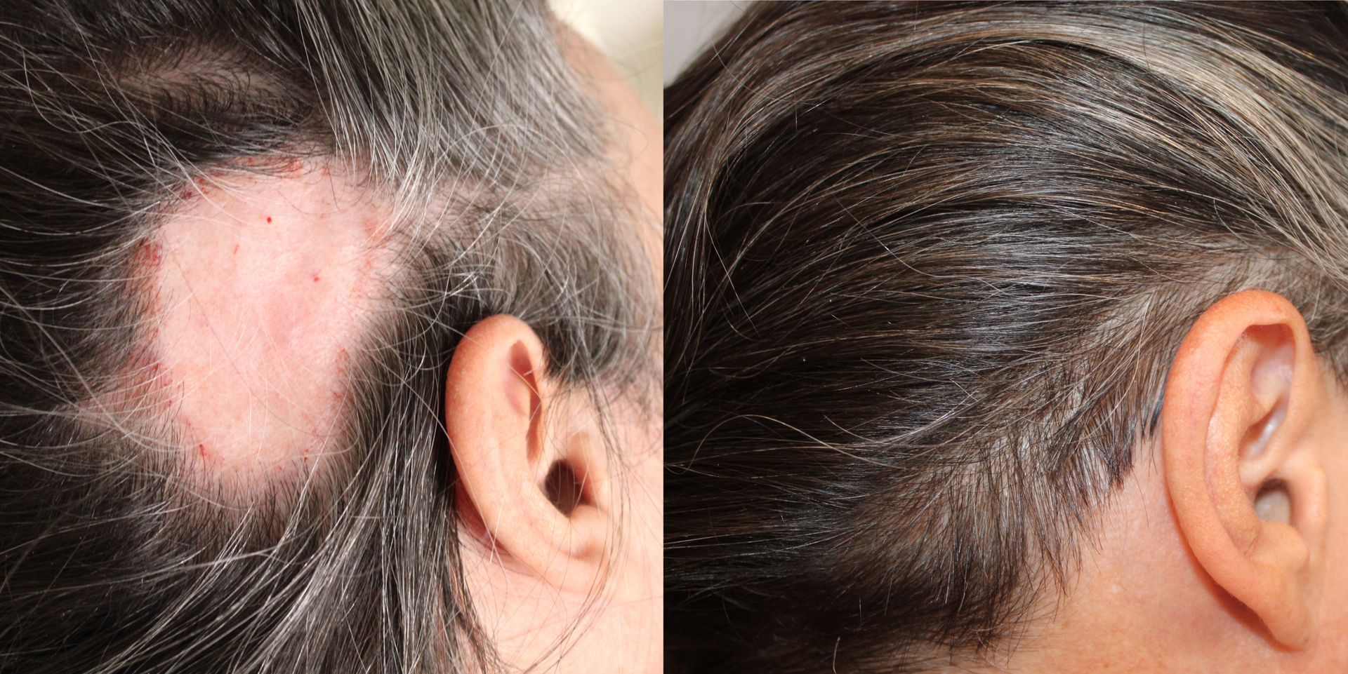 dr nettles hair loss and hair regrowth before and after pictures