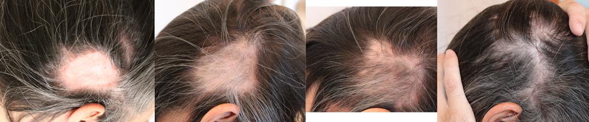 symptoms of Alopecia Areata, including round bald patches, thinning hair, and exclamation point hairs.