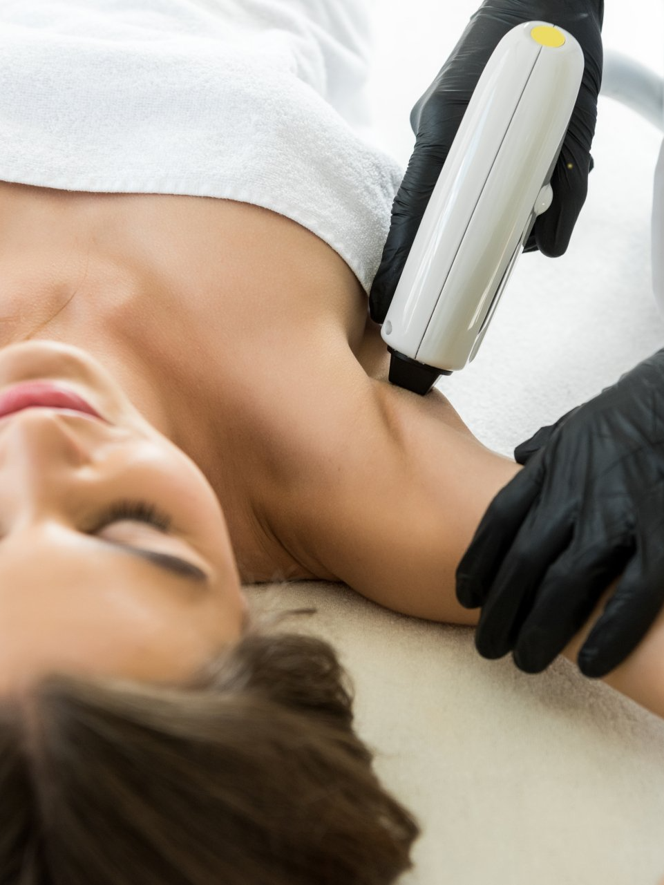 laser removal toronto