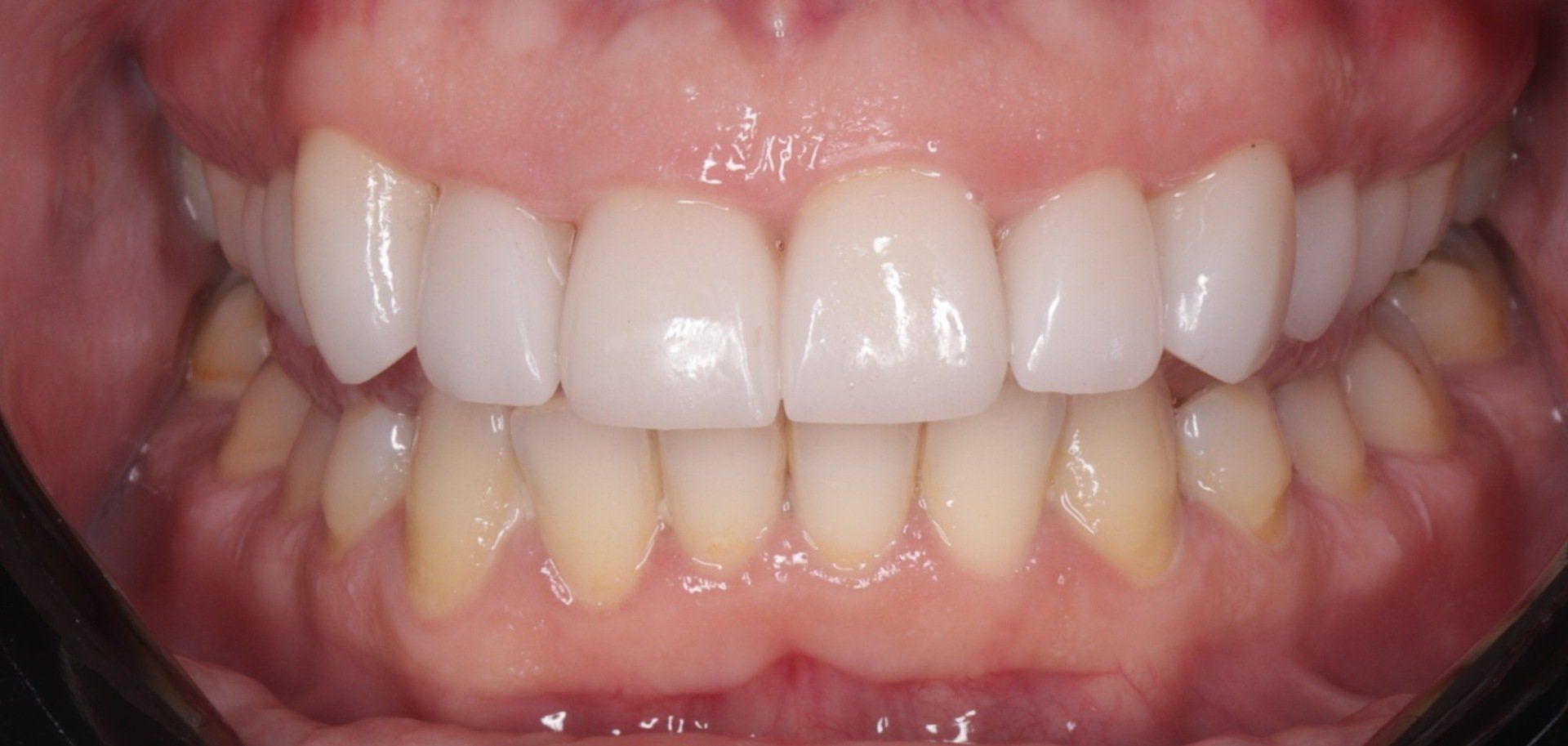 Port Smlies Dental after smile makeover services