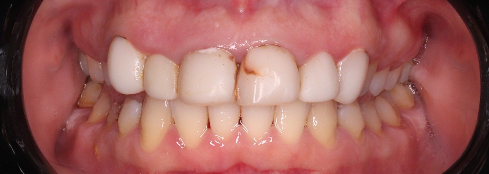 Port Smlies Dental before smile makeover