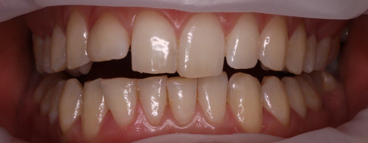 Port Smlies Dental case studies smile make over