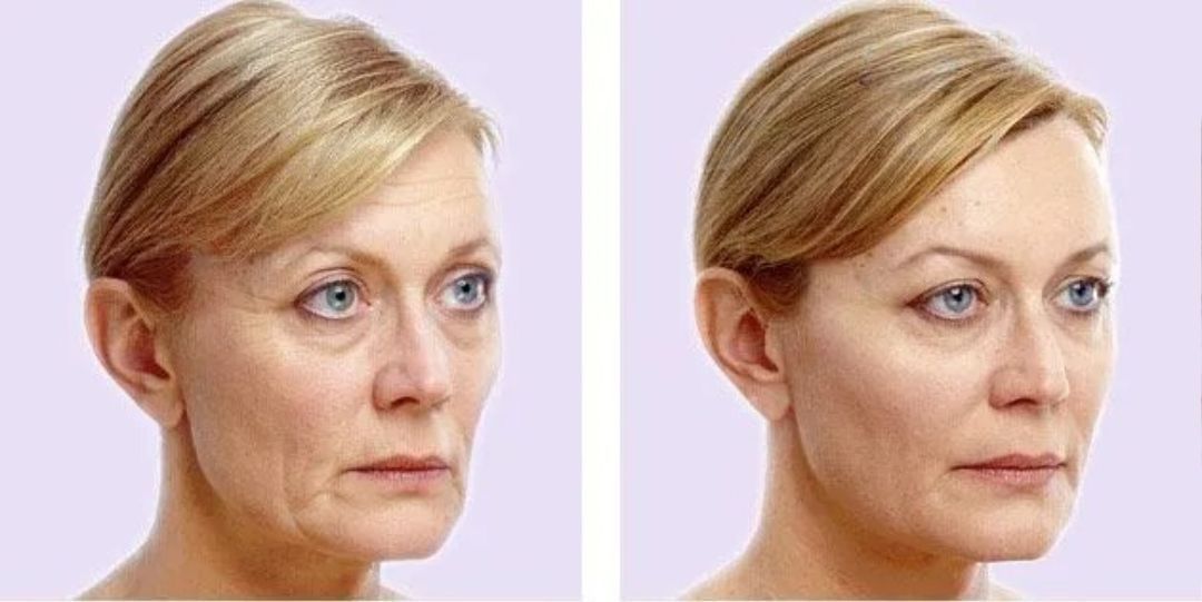 Side-by-side comparison of a woman's face, showing wrinkles on the left and smoother skin on the right.