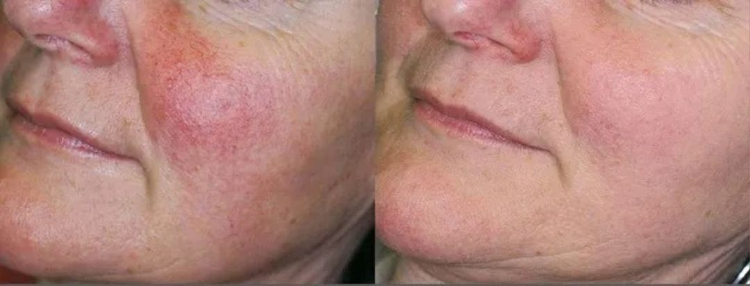 Before and after photos of a person's cheek, showing reduced redness and improved skin appearance.