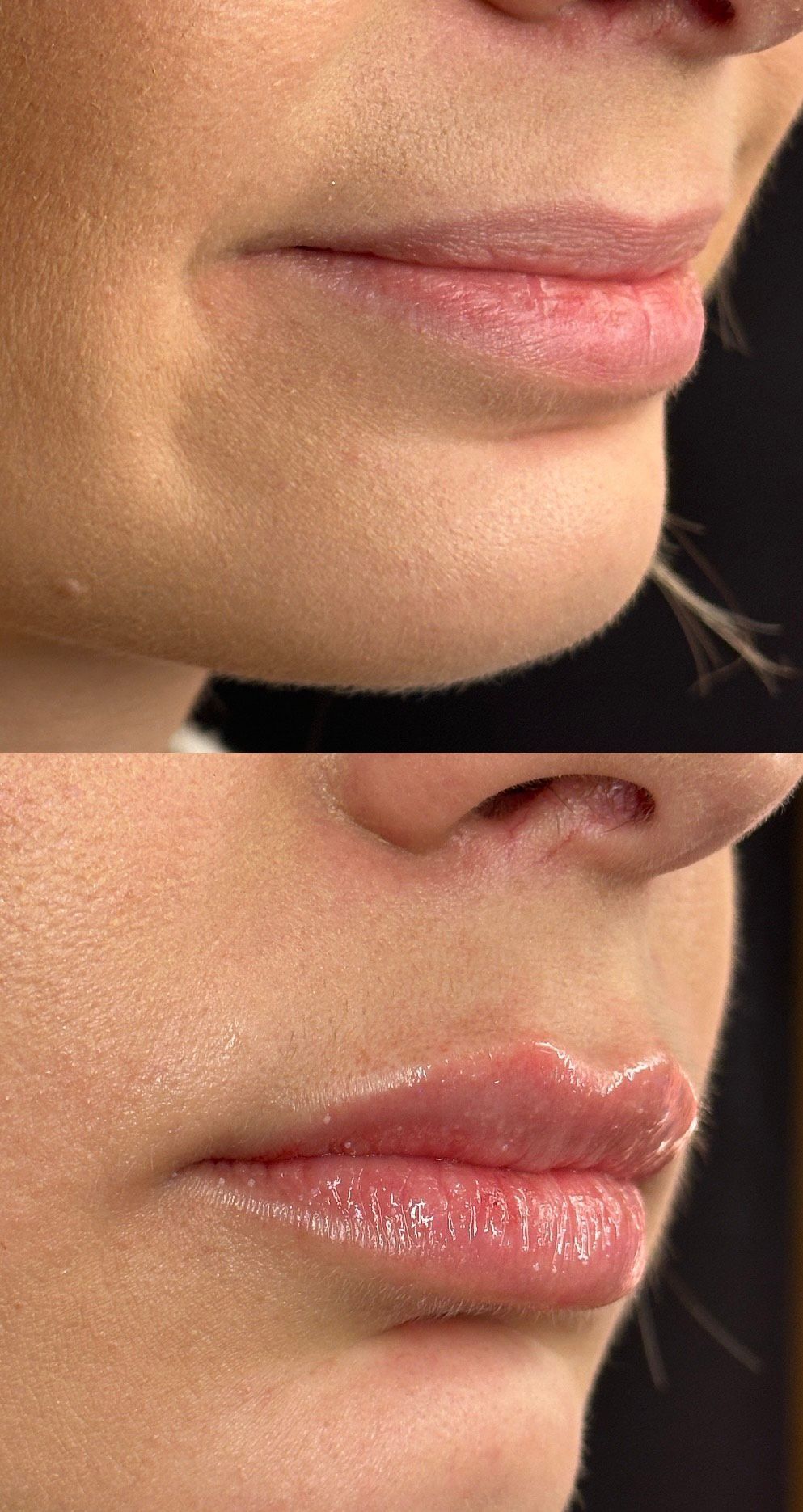 Before and after photos of lip filler. Top, natural lips. Bottom, fuller lips.