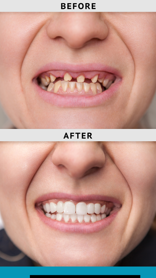 Before and After Dental Implants Merrillville