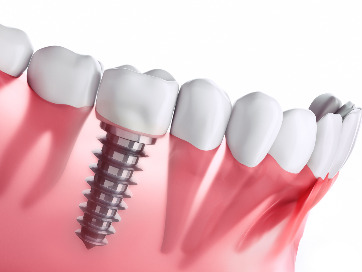 Dental Implants Merrillville