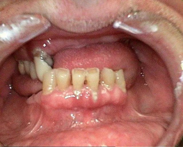 dental implants rancho cucamonga