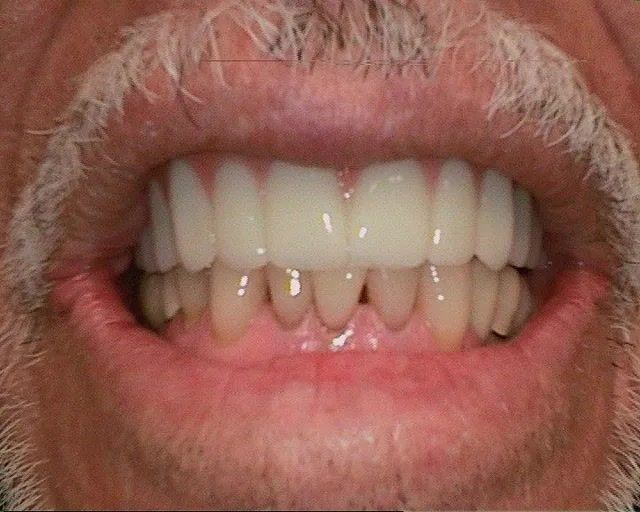 dental implants rancho cucamonga