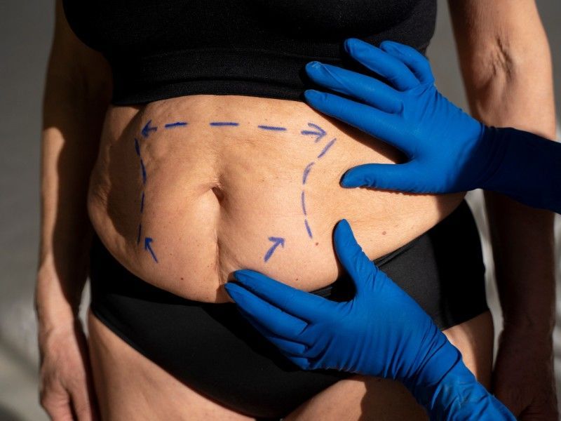 O estômago de uma mulher está sendo examinado por um médico usando luvas azuis.
