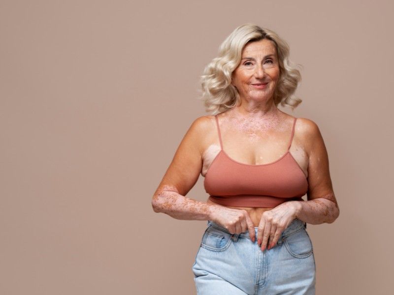 Uma mulher com vitiligo está vestindo uma blusa rosa e jeans azul.