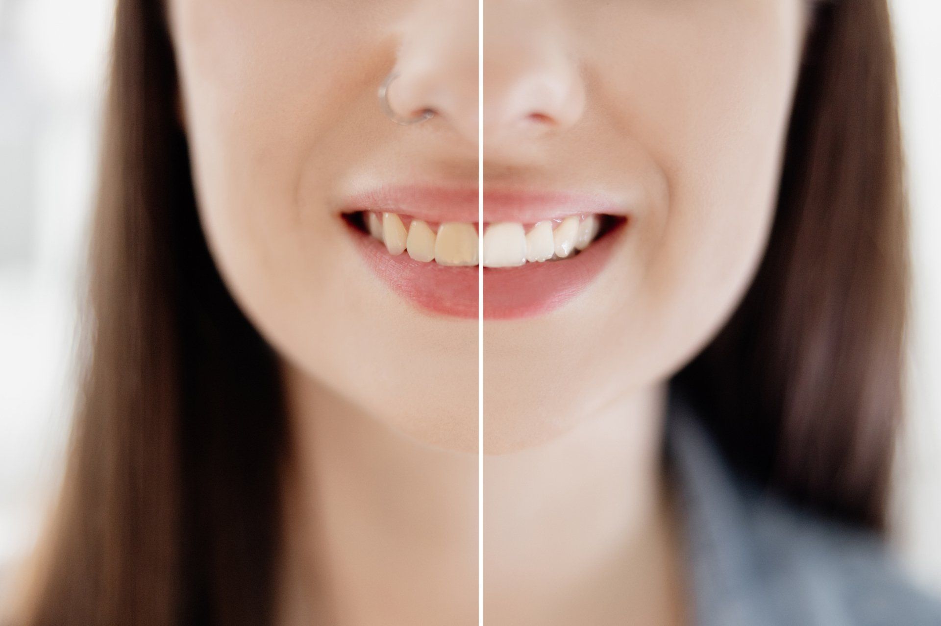 Sbiancamento dentale