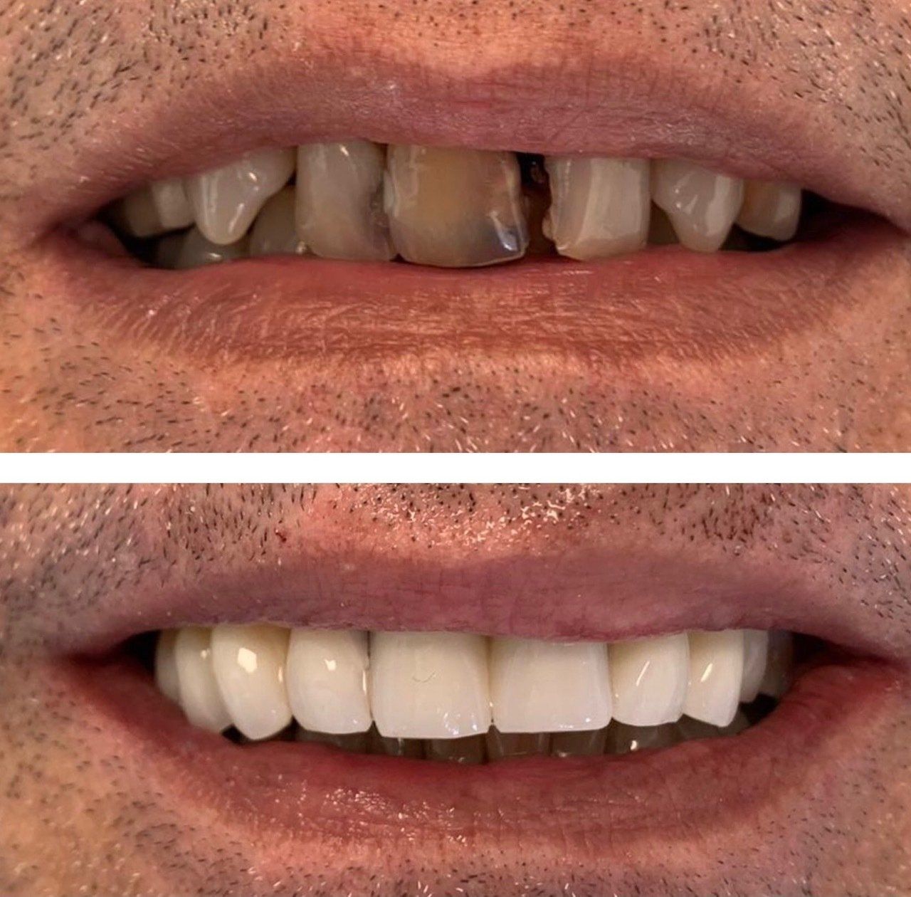 foto di implantologia dentale prima e dopo