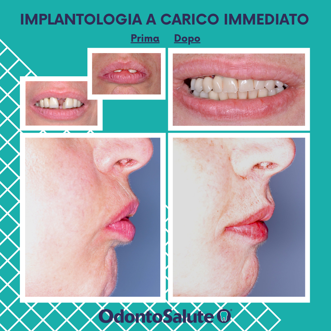foto di implantologia dentale prima e dopo