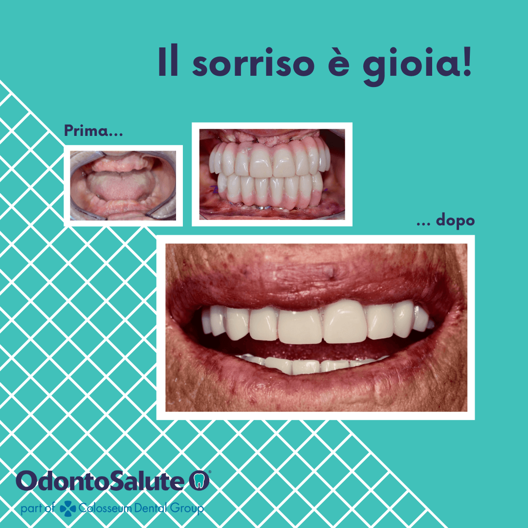 implantologia dentale