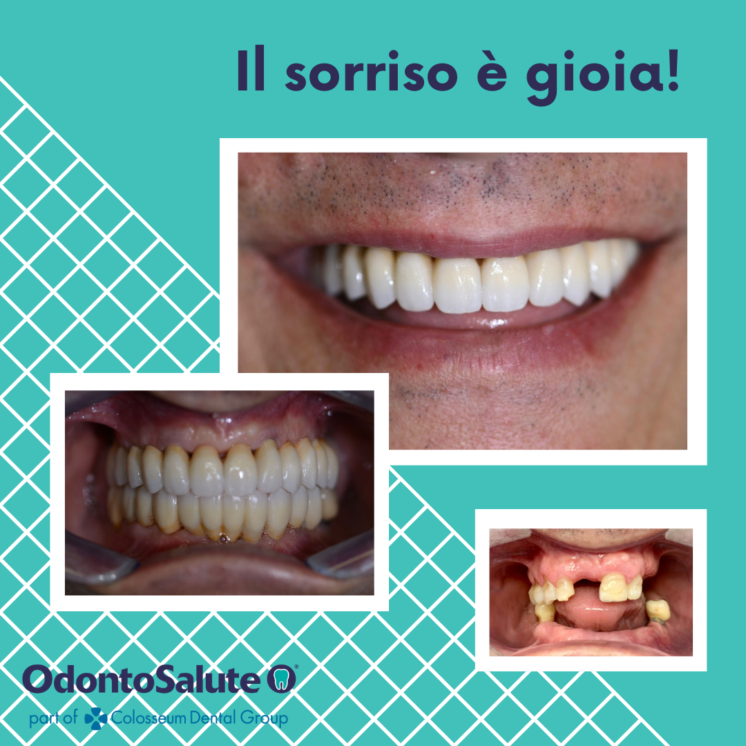 foto di implantologia dentale prima e dopo