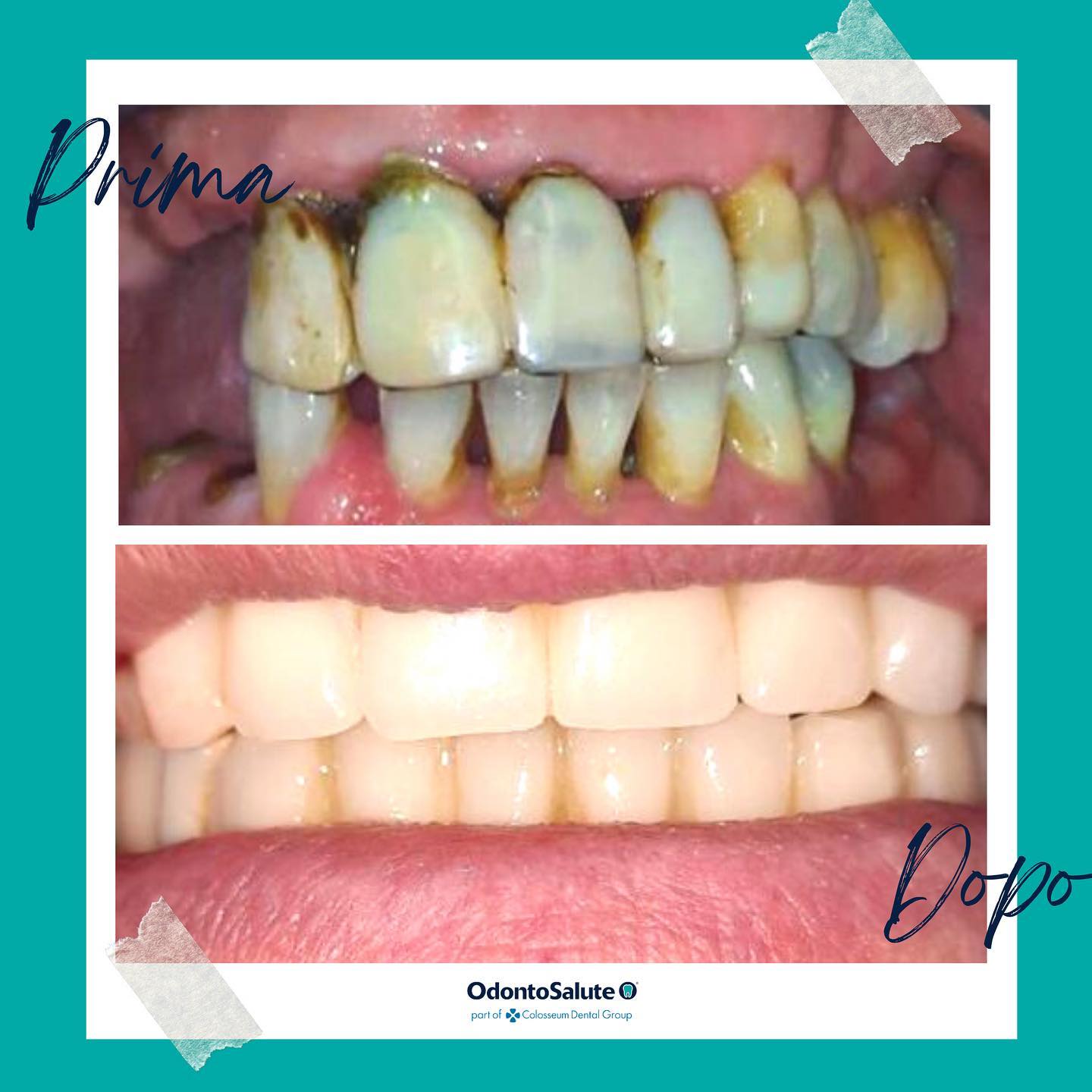 foto di implantologia dentale prima e dopo