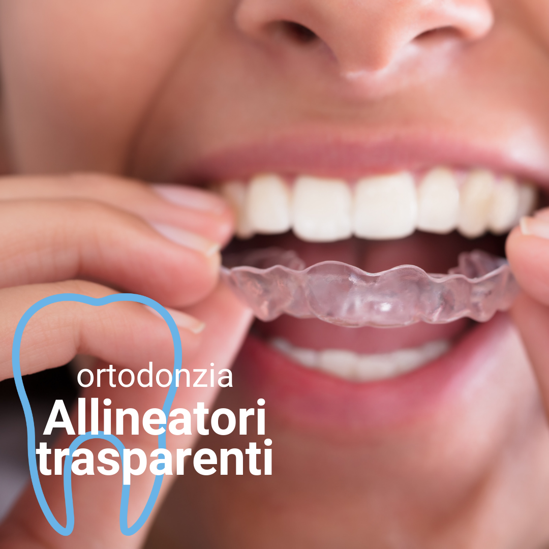allineatori trasparenti