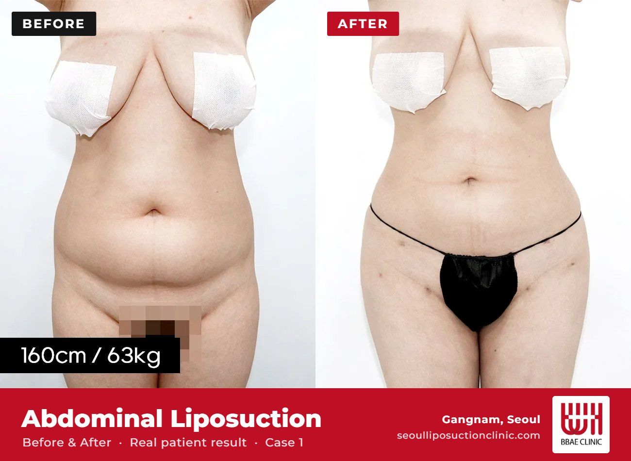 Abdominal liposuction before and after, case 1 (photo 1 of 2) – BBAE Clinic, Gangnam Seoul