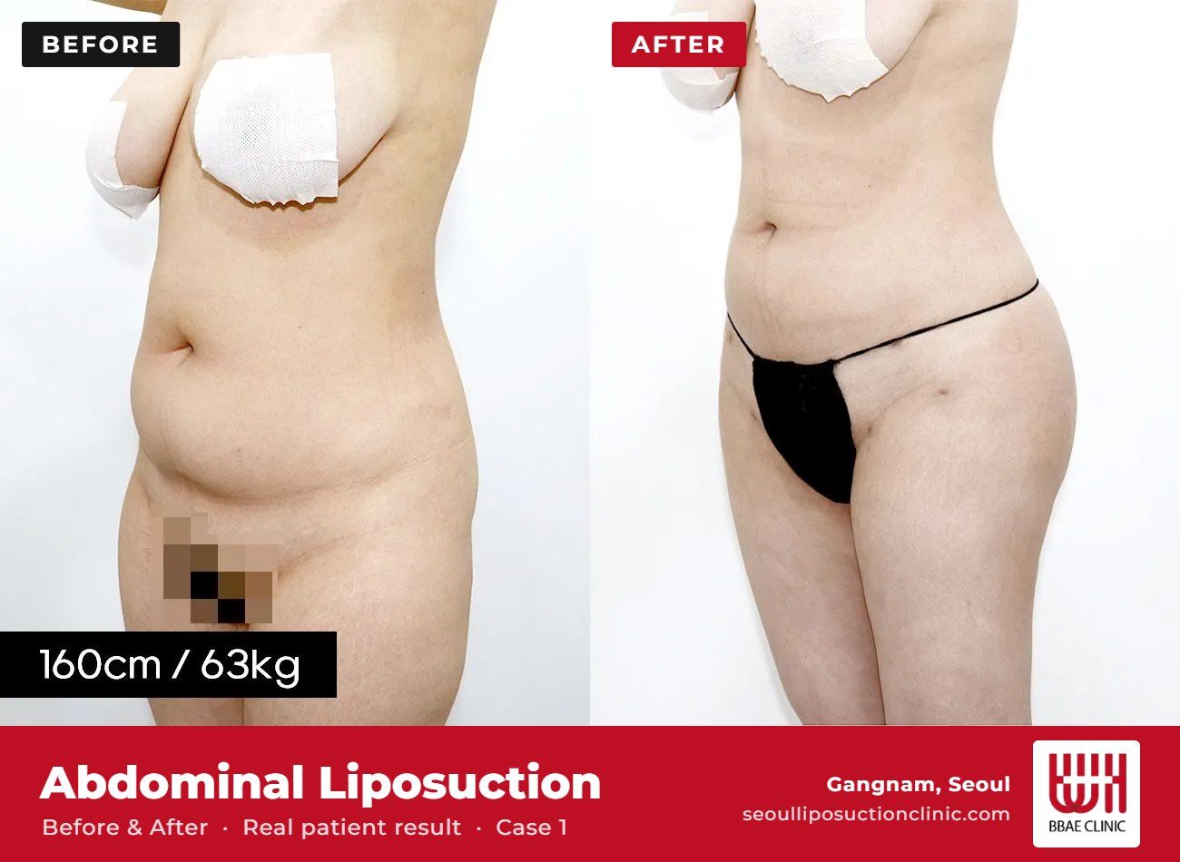 Abdominal liposuction before and after, case 1 (photo 2 of 2) – BBAE Clinic, Gangnam Seoul