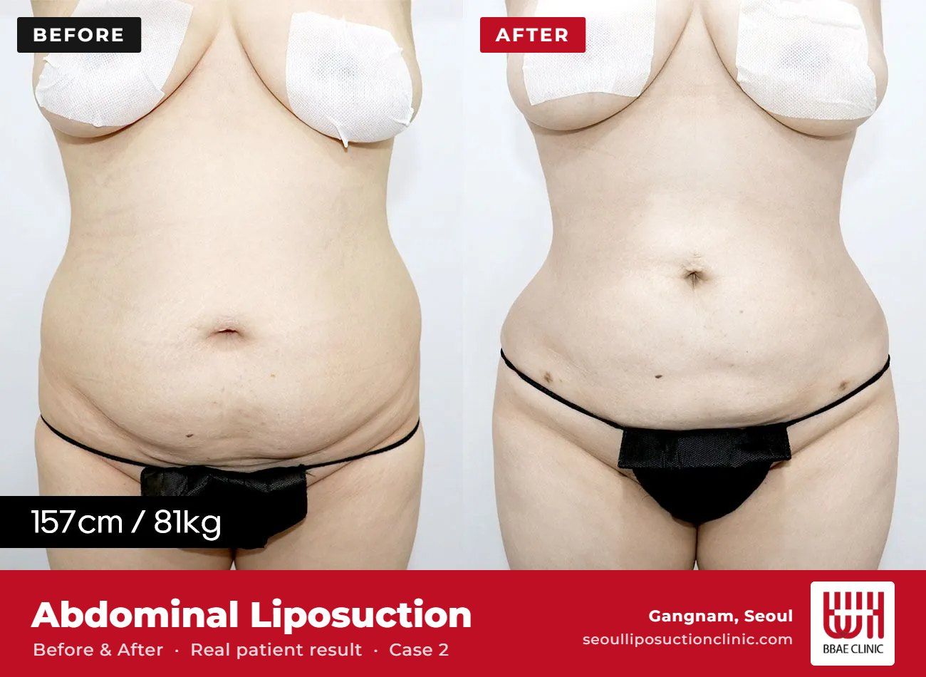 Abdominal liposuction before and after, case 2 (photo 1 of 2) – BBAE Clinic, Gangnam Seoul