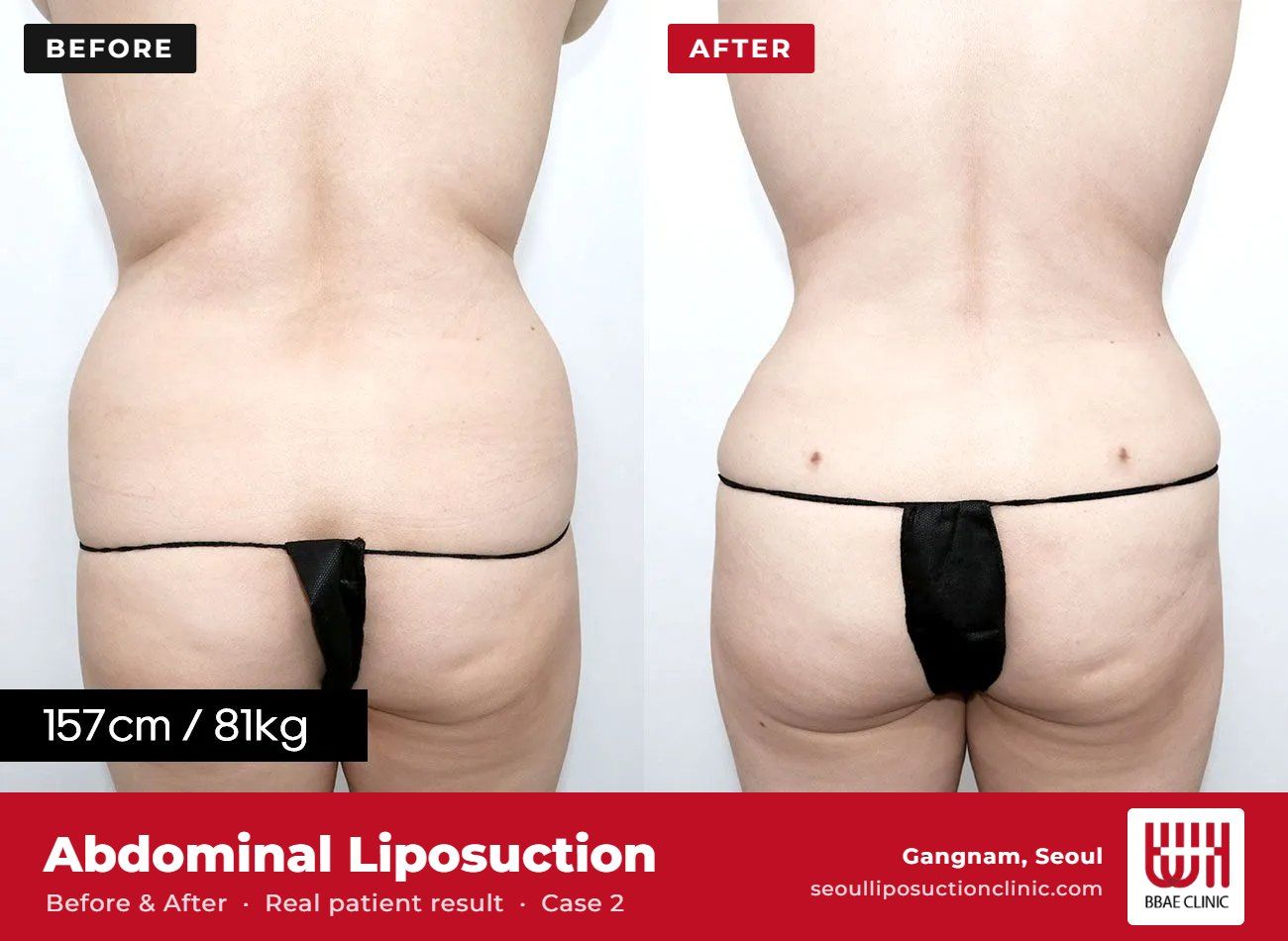 Abdominal liposuction before and after, case 2 (photo 2 of 2) – BBAE Clinic, Gangnam Seoul