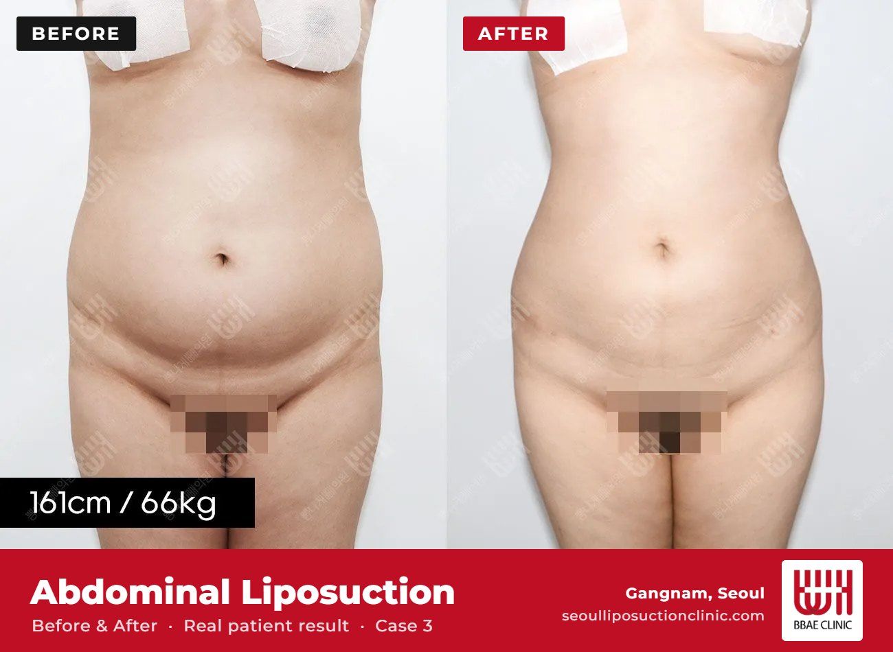 Abdominal liposuction before and after, case 3 (photo 1 of 2) – BBAE Clinic, Gangnam Seoul